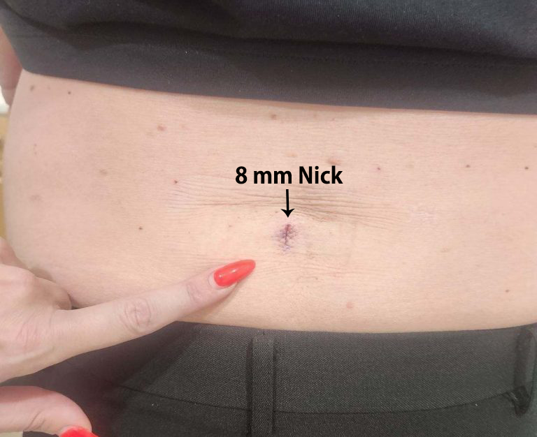 8mm skin opening for small endoscopic procedure