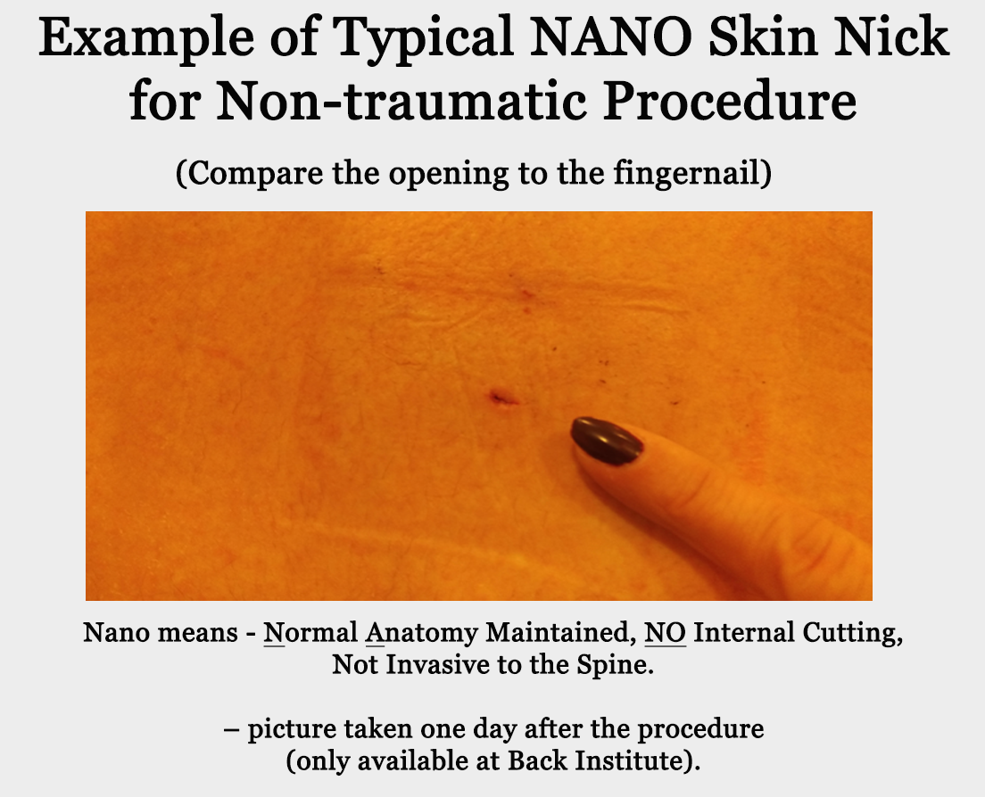 Example — 4mm nick in the skin, picture taken one day after procedure