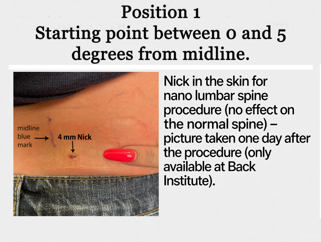 Position 1 — Starting point between 0 and 5 degrees from midline