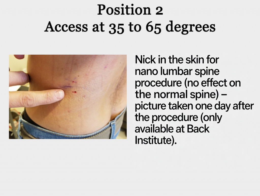 Position 2 — Nano probe insertion angle