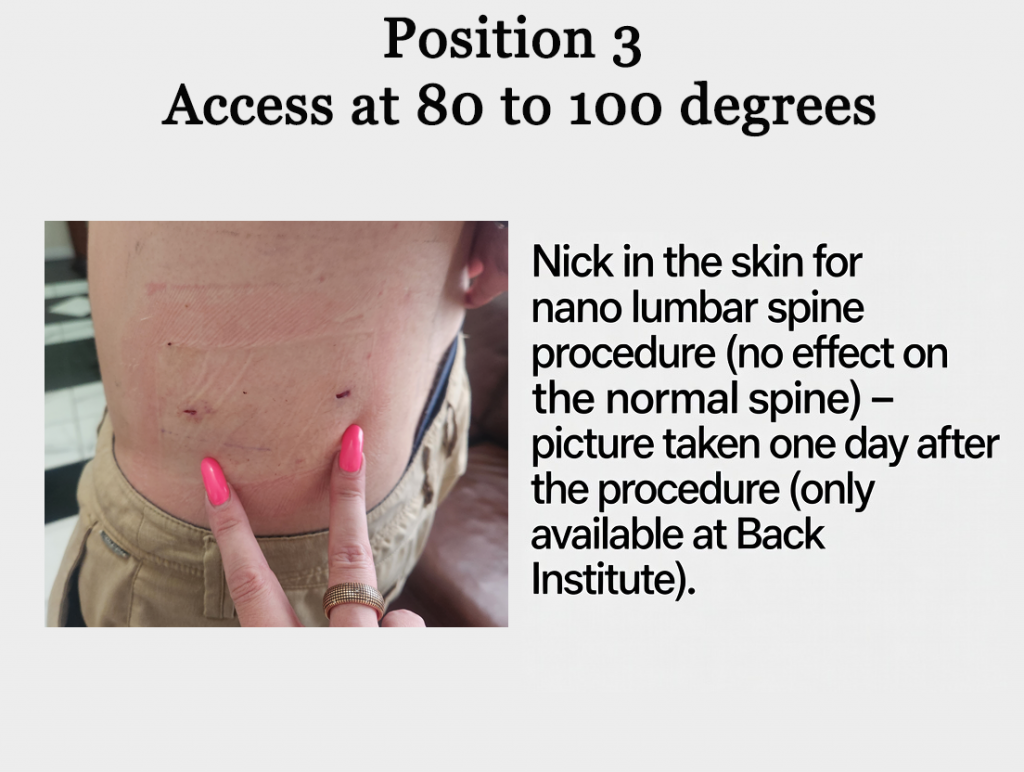 Position 3 — Lateral approach position